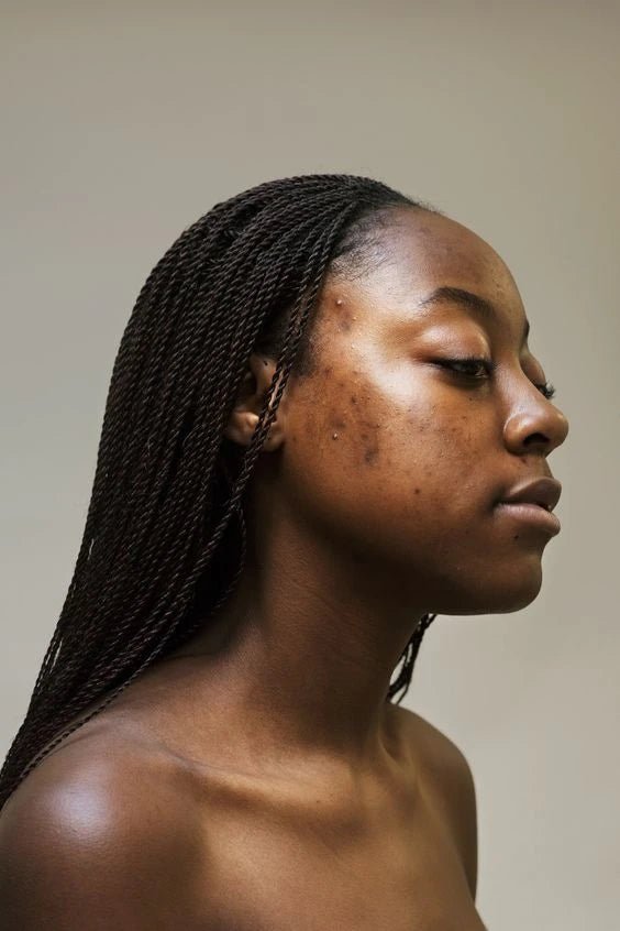 Acne Care - Koreanskinca.re