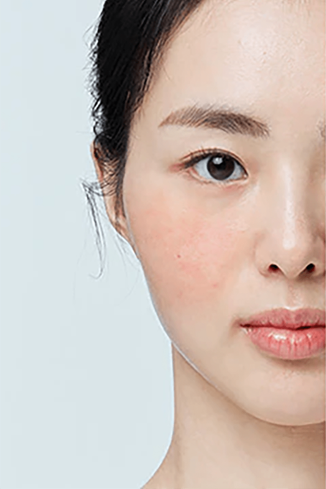 Skincare for Redness - Koreanskinca.re