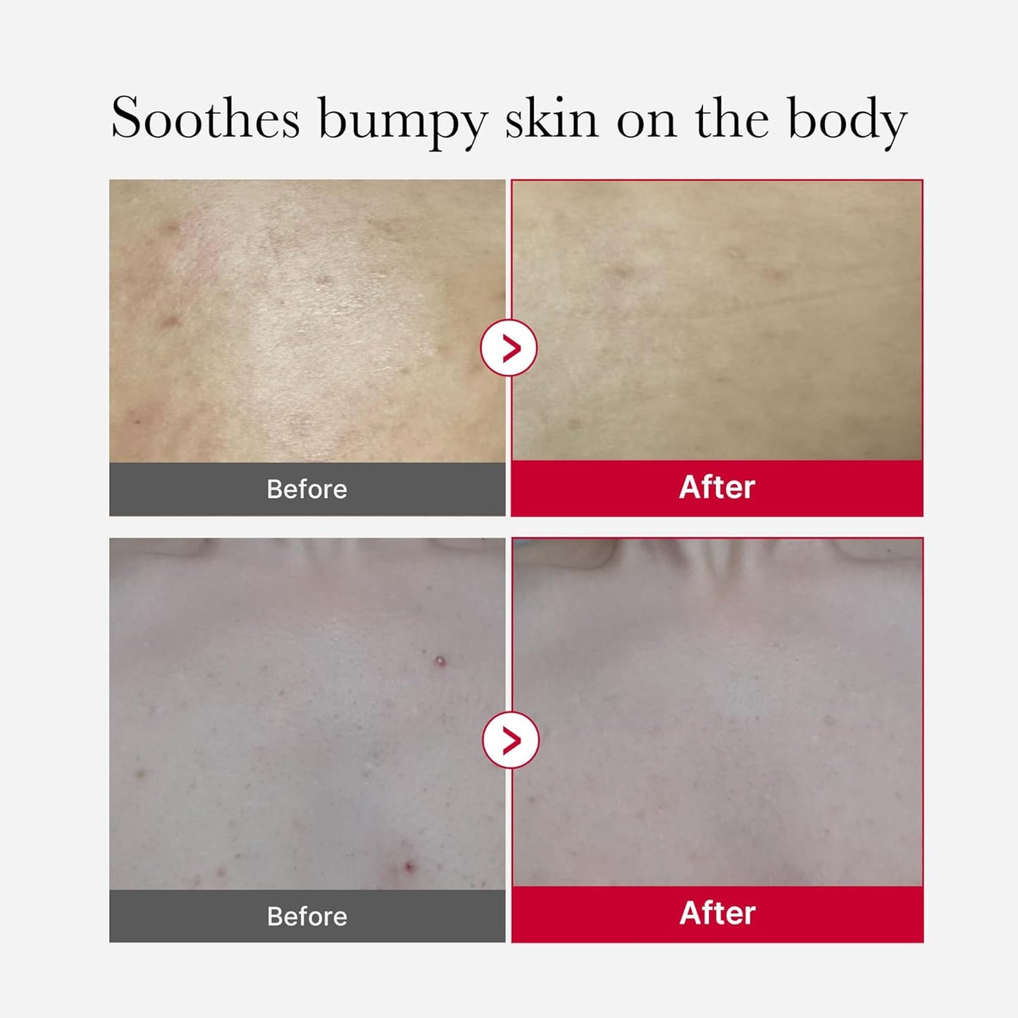 medicube Red Acne Body Peeling Shot 110g